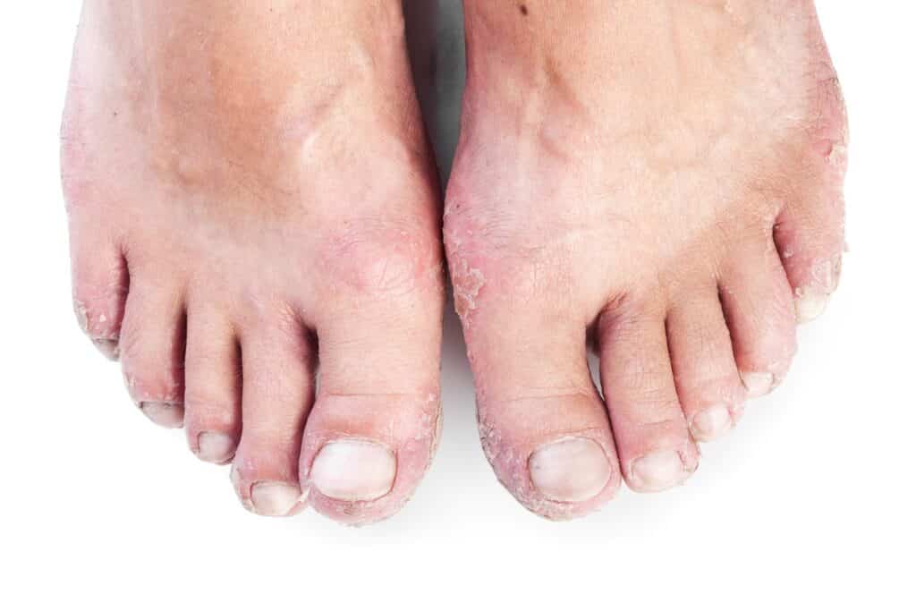 foot Skin Conditions