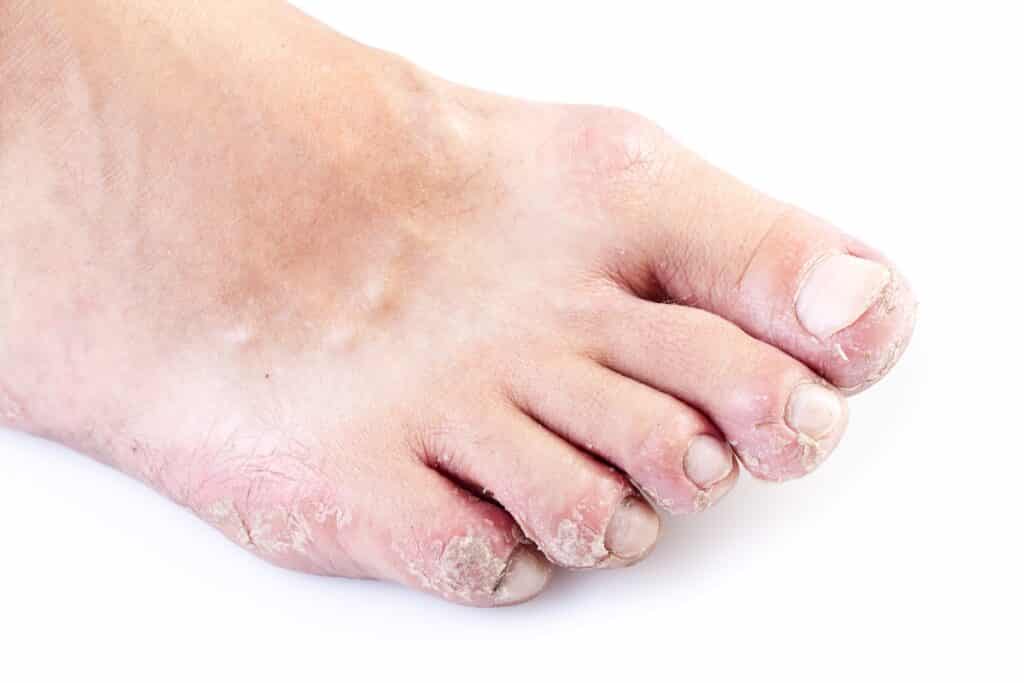 Diabetes Foot Care: How to File Buildup of Hard Skin or Corns -  HealthXchange