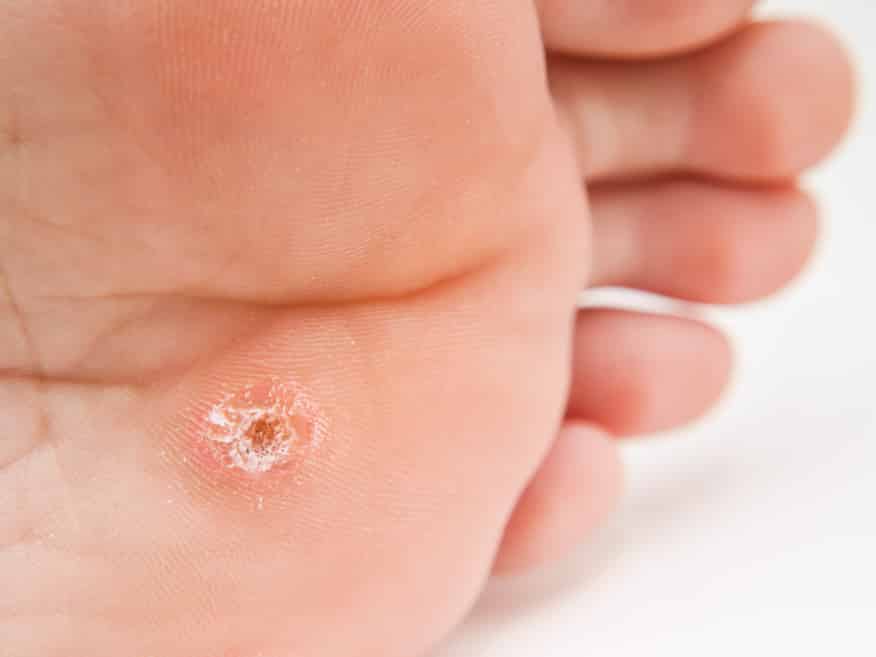 Callus vs Wart (and Corns) - Pinch Callus Removal