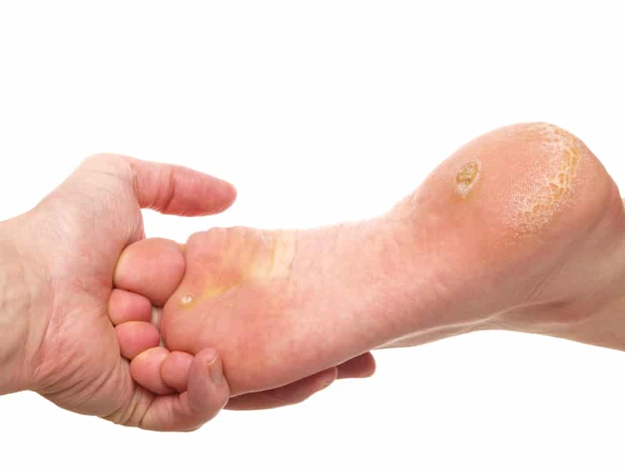 How to Use Bread & Lemon to Remove Calluses and Corns