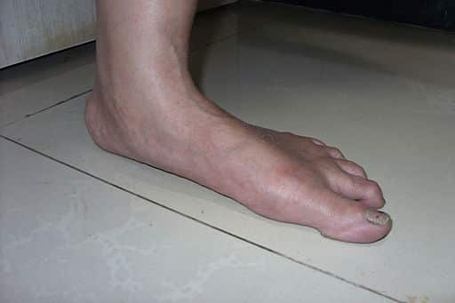 foot atrophy