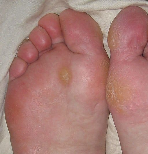 10 Ways To Remove Dead Skin From Your Feet