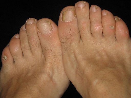 How Do You Get Rid Of Calluses Permanently? 