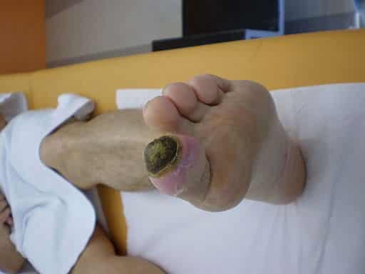 diabetic foot