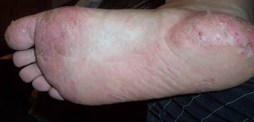 Dyshidrosis sole