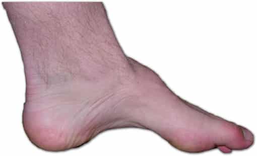 Charcot marie tooth foot