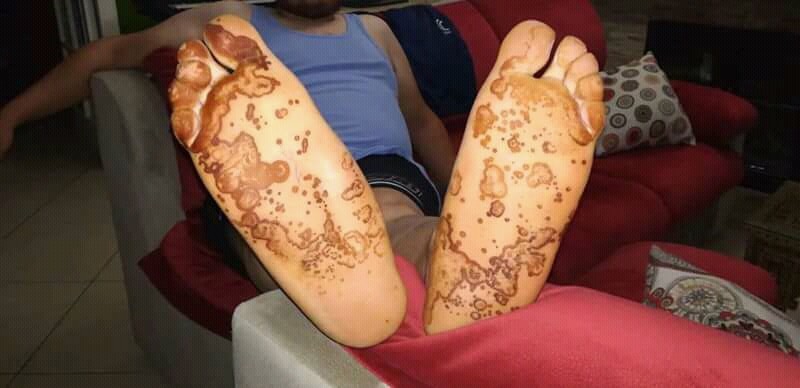 Keratoderma