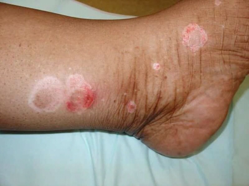 Woronoff sign psoriasis